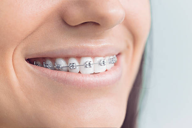 Best Traditional Braces  in Staunton, IL